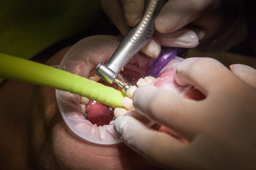 Operacja usunięcia zęba